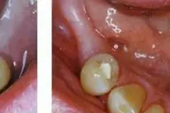 Pachet stomatologic: consultatie, detartraj si plombe