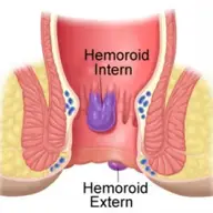 Hemoroizii