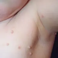 Dermatologie pediatrica - Molluscum Contagiosum