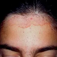 Dermatita Seboreica