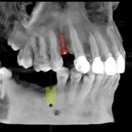 Implanturile dentare si importanta planificarii interventiei