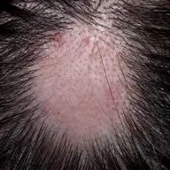 Alopecia