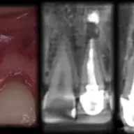 Dentcof - Rezectie Apicala