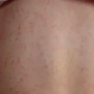 Scarlatina