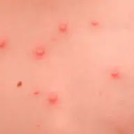 Varicela