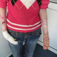 Apel umanitar: Oana sufera de o maladie rara care ii macina pielea si oasele
