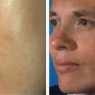 Sfaturi pentru pacienti cu melasma