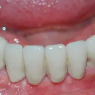 Ce presupune un implant dentar