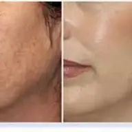 Peeling chimic cu acid glicolic