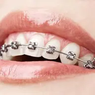 Celebritati care au purtat aparat dentar pentru adulti