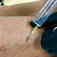 Beneficiile ozonoterapiei
