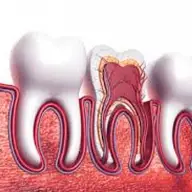 Tratamentul endodontic in Timisoara