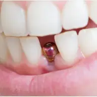 Implantul dentar - 4 mituri despre cea mai populara procedura de inlocuire a dintilor pierduti
