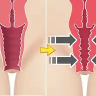 Rejuvenare vaginala în Timisoara