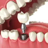 Ce trebuie să știi despre implanturile dentare?