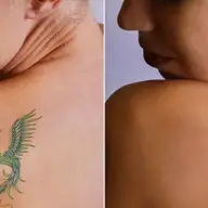 Indepartarea tatuajelor cu laser la Timisoara