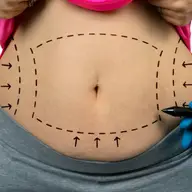 Abdominoplastie sau liposucție - informatii generale