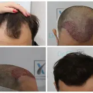 Clinica Dr. Felix Hair Implant te ajută cu un implant de păr reușit
