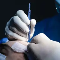 Transplant de păr: o solutie permanentă pentru calvitie