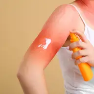 Alergia solară