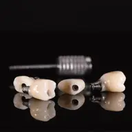 Tot ce trebuie să stiți despre implantul dentar la Eiffel Praxis