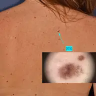 Prevenția și depistarea precoce a cancerelor de piele vă poate salva viața