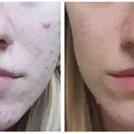 Acneea, de ce nu trebuie ignorată și cum poate fi tratată eficient