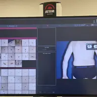 Harta alunițe în Timișoara: monitorizarea alunițelor cu platforma de videodermatoscopie FotoFinder