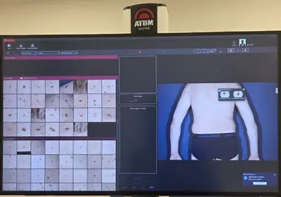 Harta alunițe în Timișoara: monitorizarea alunițelor cu platforma de videodermatoscopie FotoFinder