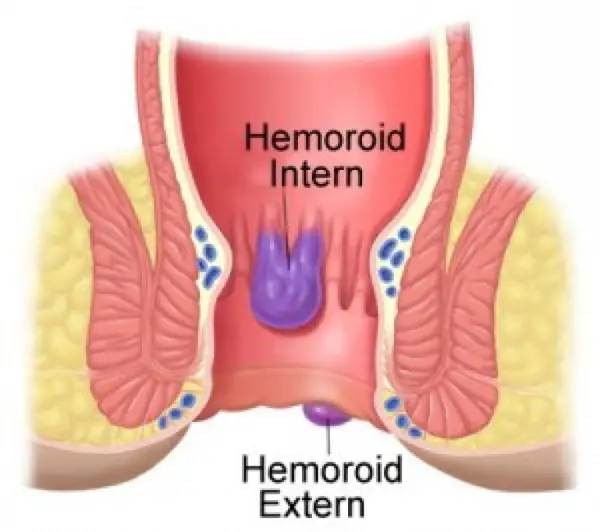 Hemoroizii