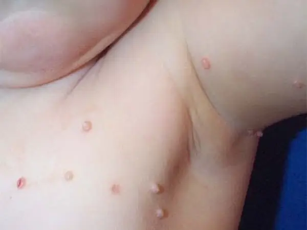 Dermatologie pediatrica - Molluscum Contagiosum