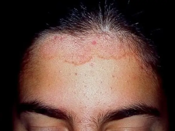 Dermatita Seboreica