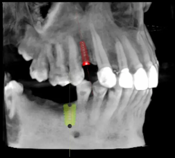 Implanturile dentare si importanta planificarii interventiei