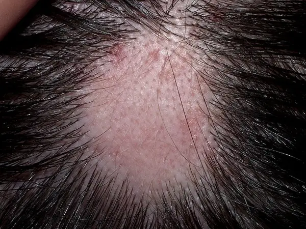 Alopecia