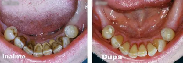 Pachet stomatologic: consultatie, detartraj si plombe