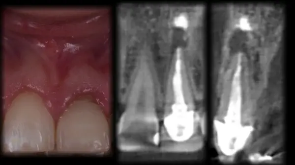 Dentcof - Rezectie Apicala