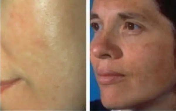 Sfaturi pentru pacienti cu melasma