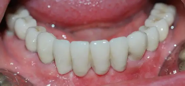Ce presupune un implant dentar