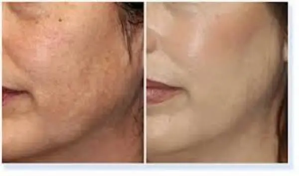 Peeling chimic cu acid glicolic