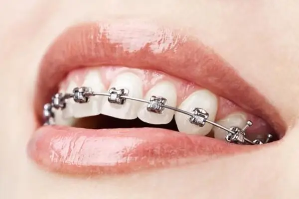 Celebritati care au purtat aparat dentar pentru adulti