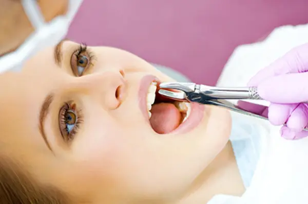 Extractii dentare in Timisoara