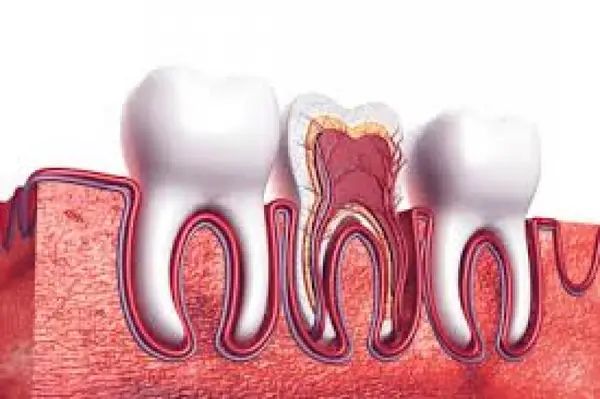 Tratamentul endodontic in Timisoara