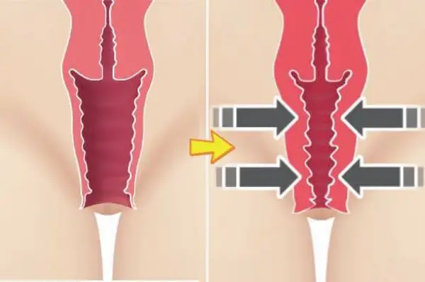 Rejuvenare vaginala în Timisoara