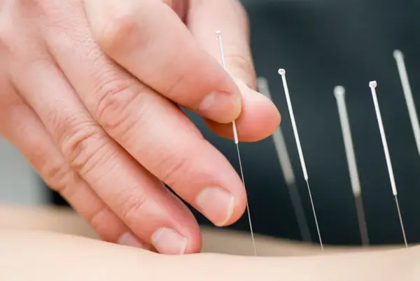 Cauti preturi tratamente acupunctura cat mai bune? Apeleaza la acupuncturabucuresti.ro