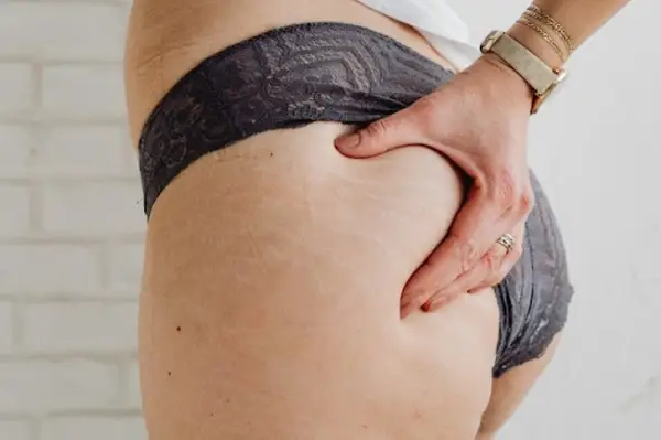 Cum scapi de vergeturi: 5 metode eficiente