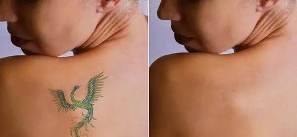 Indepartarea tatuajelor cu laser la Timisoara