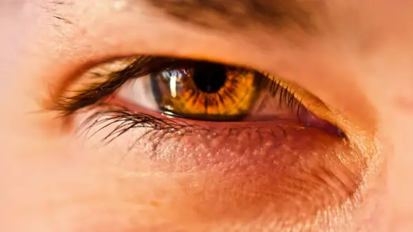 Blefaroplastia - moft sau necesitate