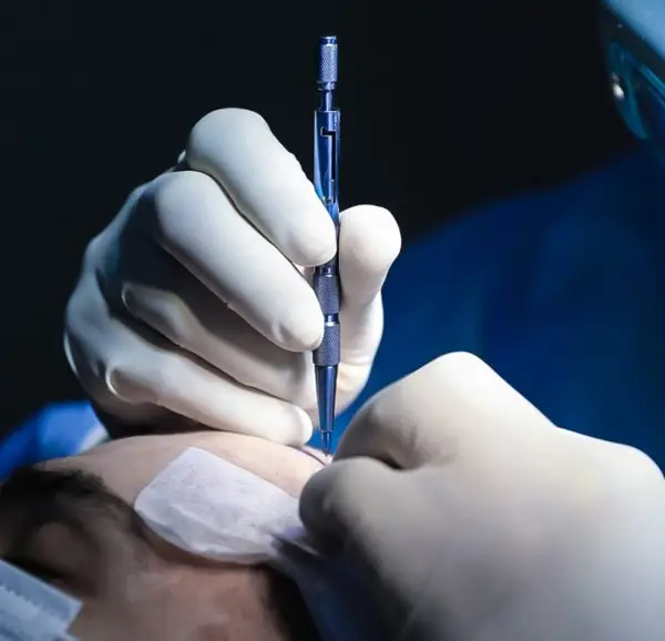 Transplant de păr: o solutie permanentă pentru calvitie