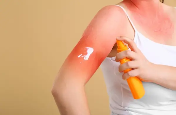Alergia solară