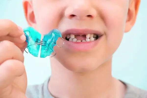 Aparatele dentare mobile pentru copii: o metodă preventivă de succes